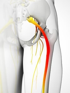 sciatica and sciatic nerve from gluteal buttocks to leg