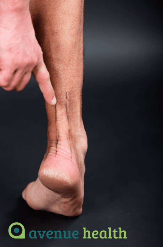 Achilles Tendinitis Treatment | Heel Pain | Symptoms | Causes
