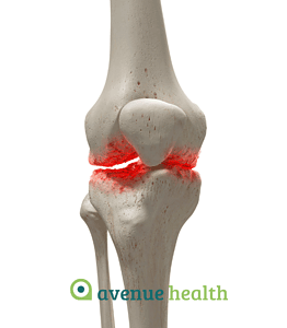 Knee joint with inflammation and arthritis, arthritic conditions