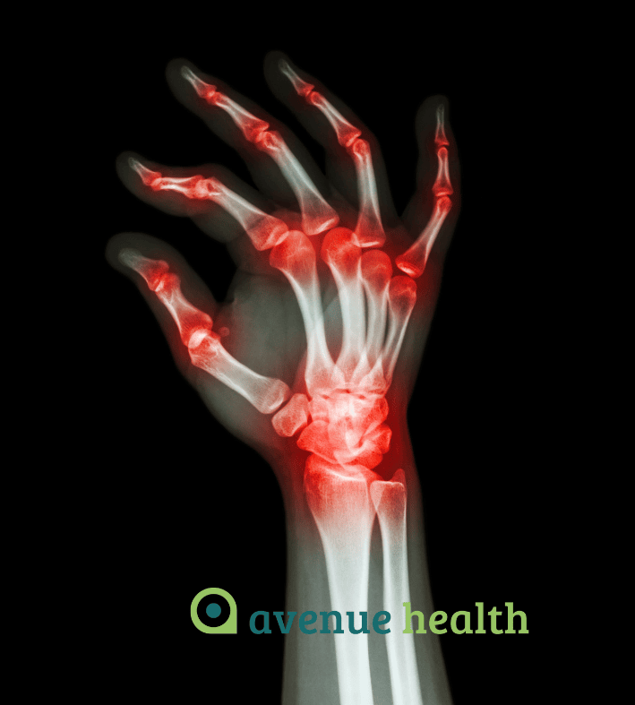 X-ray of hand with inflamed joints
